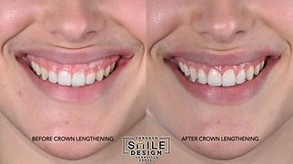 L’Appartement GOOD GRIEF Smile Compact Mini_Syntette_Anterior_SD_275-